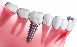 İmplant Tedavisi Diş Çekiminden Daha Kolay